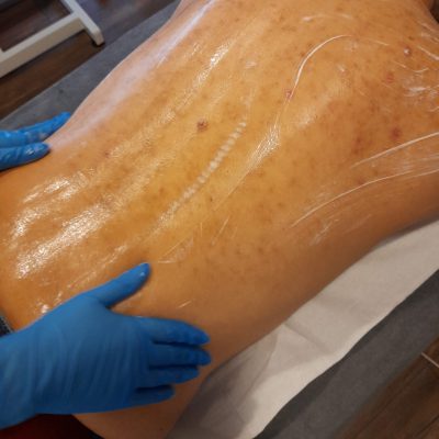 Rug met Acne die behandeld wordt